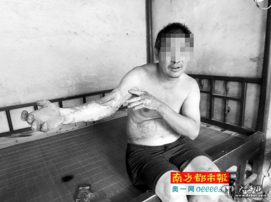 去年6月，為阻止女兒和一男子約會，氣頭上的李春生忘了關煤氣閥門，全身被燒燙傷68%。